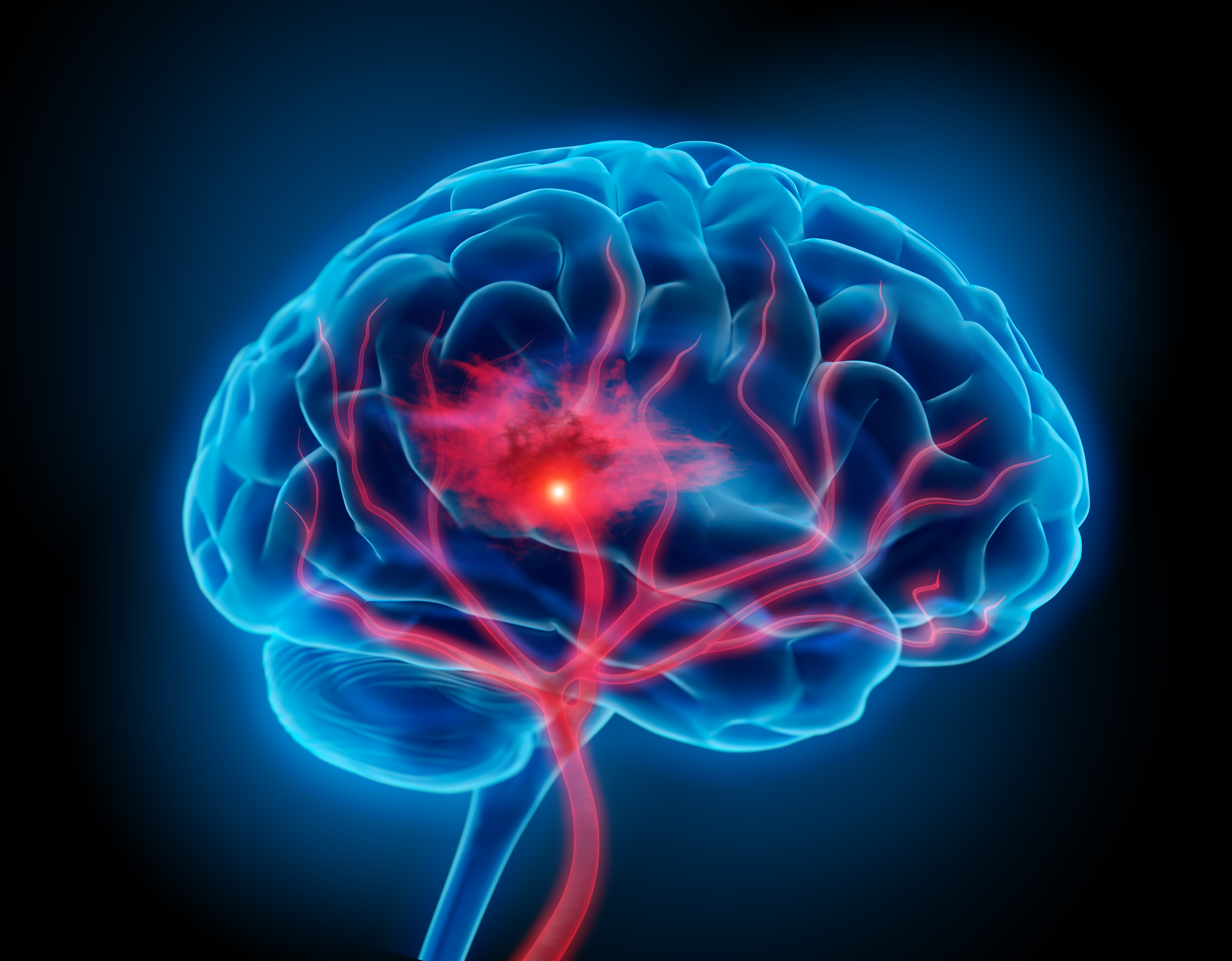 Image of stroke in the head