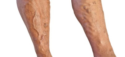 Varicose Veins