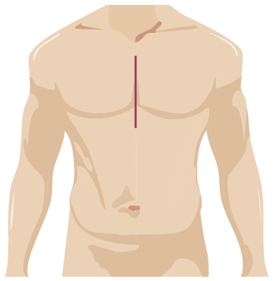 Traditional surgery incision