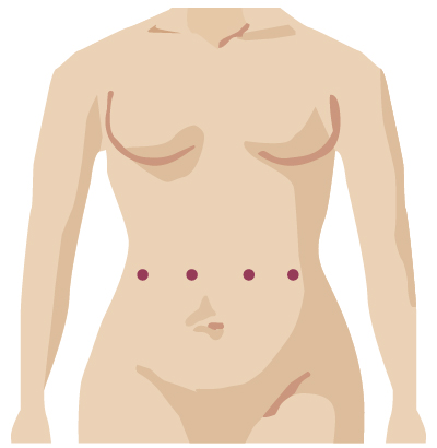 Robotic surgery incision from urogynecologic surgery