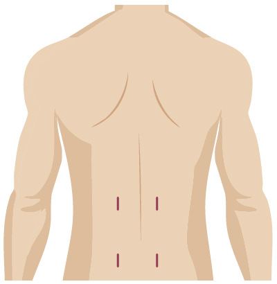 Minimal scars from robotic spine surgery