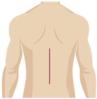 Traditional surgery incision from spine surgery
