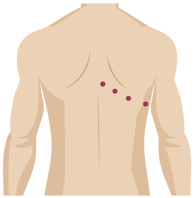 Robotic surgery incision from thoracic surgery