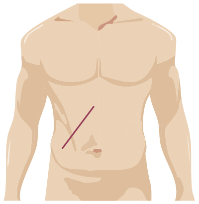 Traditional surgery incision from urology surgery