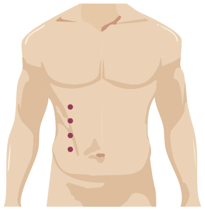 Robotic surgery incision from urology surgery